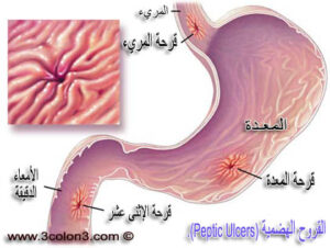 القروح الهضمية (Peptic Ulcers)